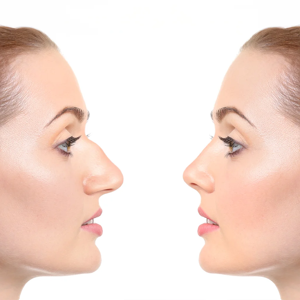 Türkiye rhinoplasty aesthetic surgery ile doğal ve estetik burun cerrahisi.