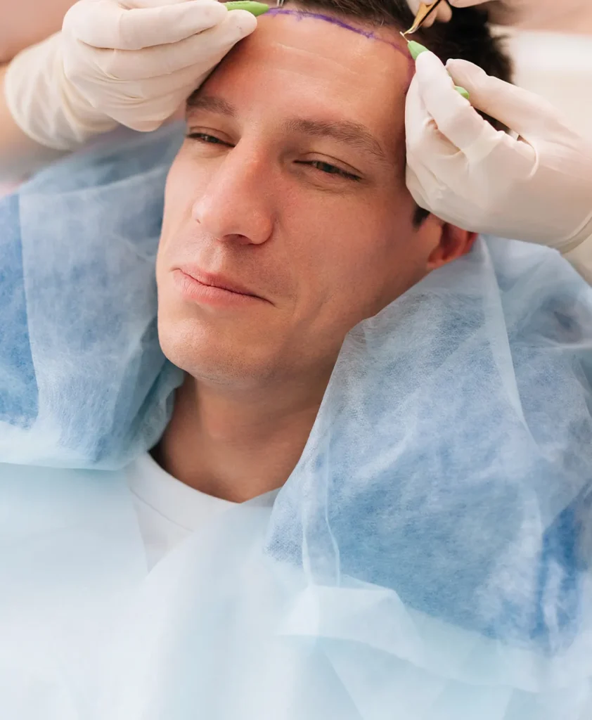 Türkiye'de Safir Perkütan yöntemi öncesi ve sonrası, doğal saç çizgisi ve geri kazandırılan saç yoğunluğunu gösteren sonuçlar.