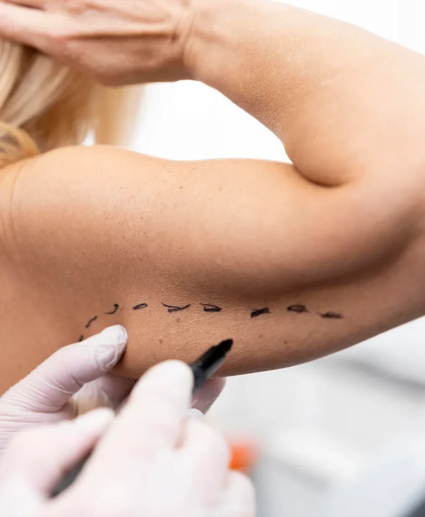 Brachioplasty procedure in Turkey designed to tighten loose skin and improve the appearance of the arms.