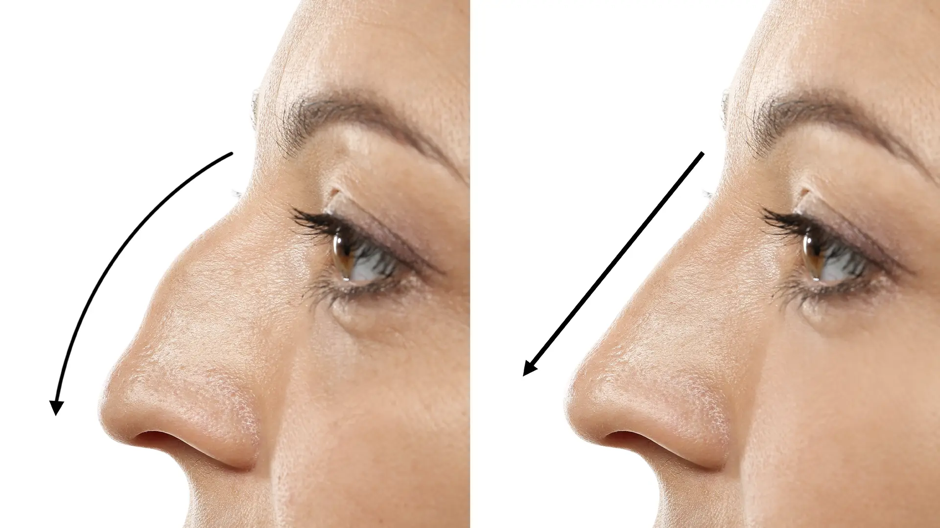 Close-up of a nose being sculpted with ultrasound rhinoplasty technology for thick skin, showing precise and gentle shaping.
