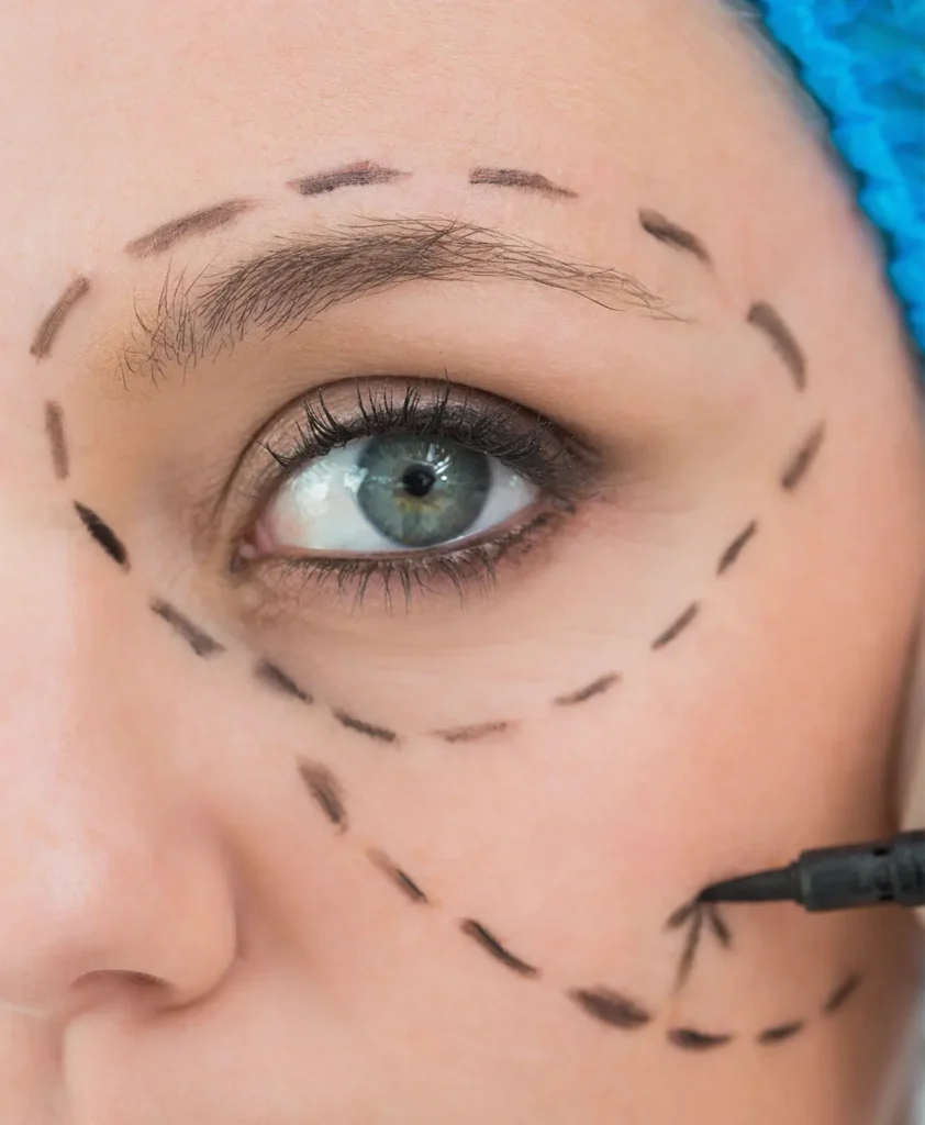 Recovery after Endoscopic Eyebrow Lift in Turkey with professional care for safe healing and long-lasting results.