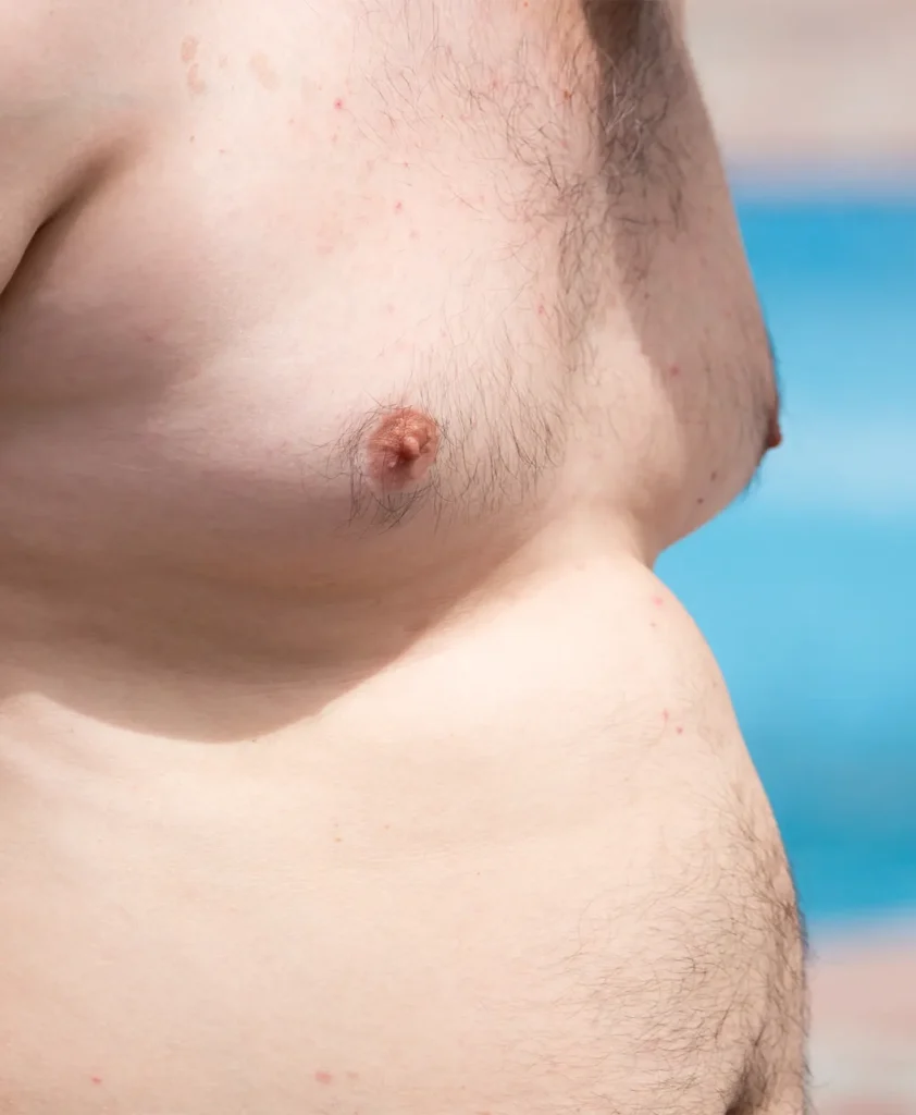 Recovery after gynecomastia surgery in Turkey, ensuring safe healing and long-lasting, natural-looking results.