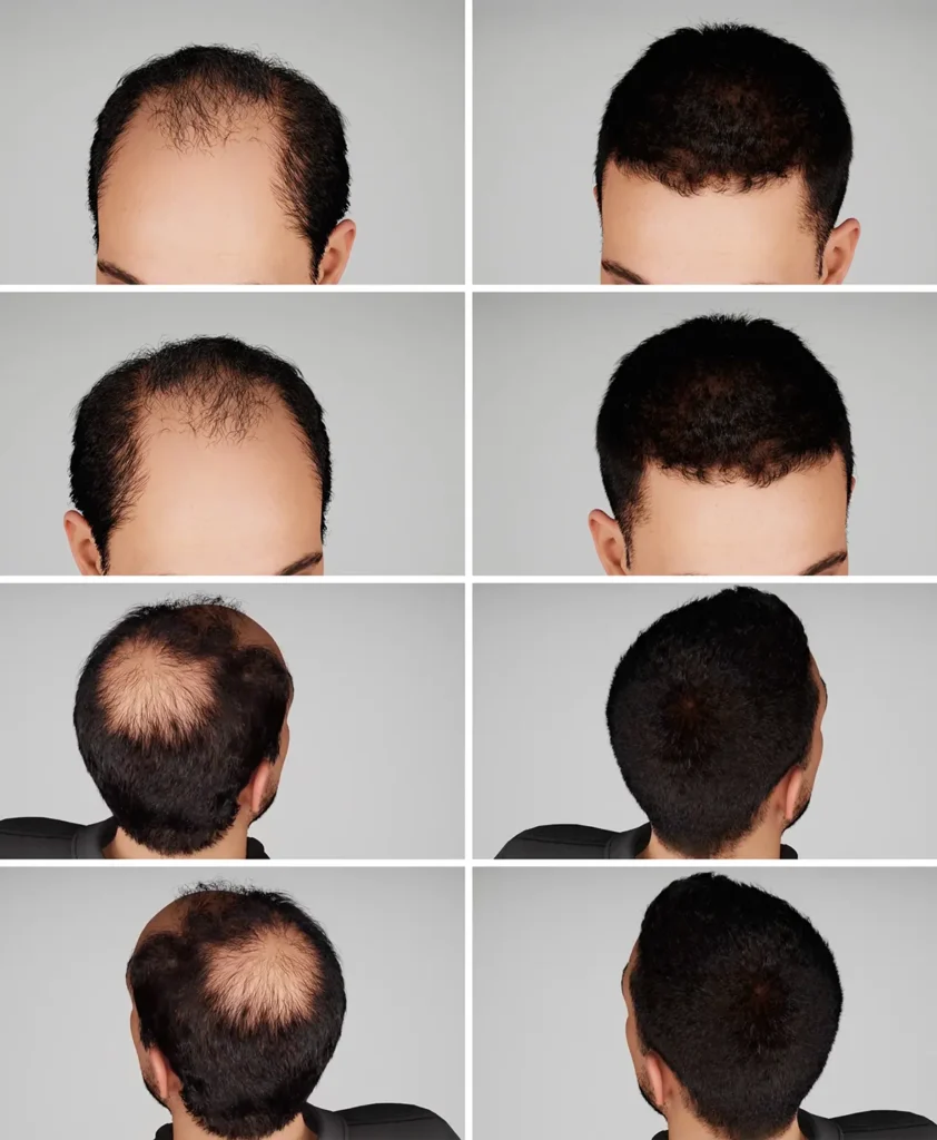 Recovery after Hair Transplant in Turkey with professional care to ensure optimal hair growth and safe healing.