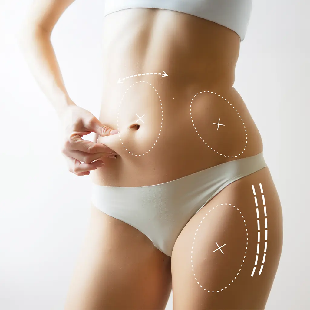 Liposuction body contouring procedure performed by experienced aesthetic surgeons at a modern clinic in Turkey.
