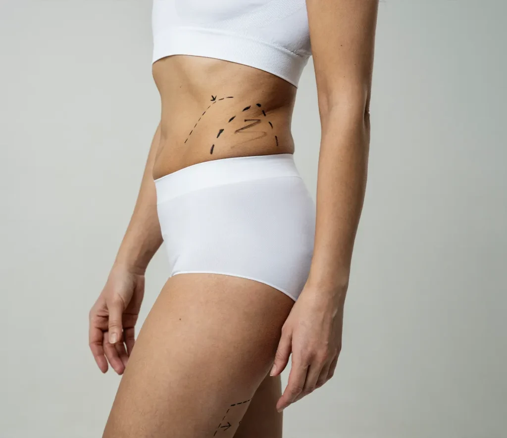 Thigh liposuction in Turkey to remove stubborn fat and enhance body contours with professional care.