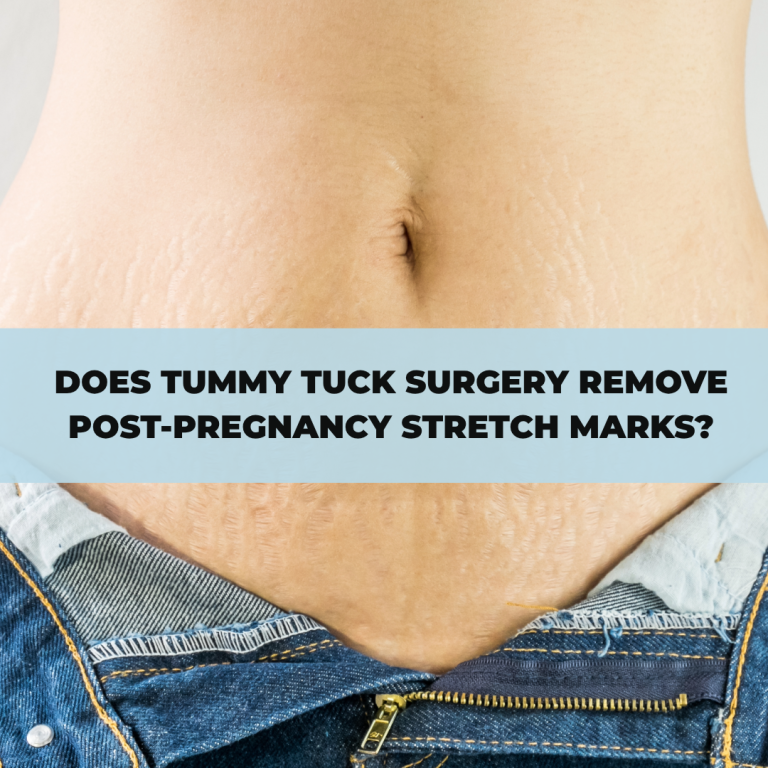 Does Tummy Tuck Surgery Remove Post-Pregnancy Stretch Marks?