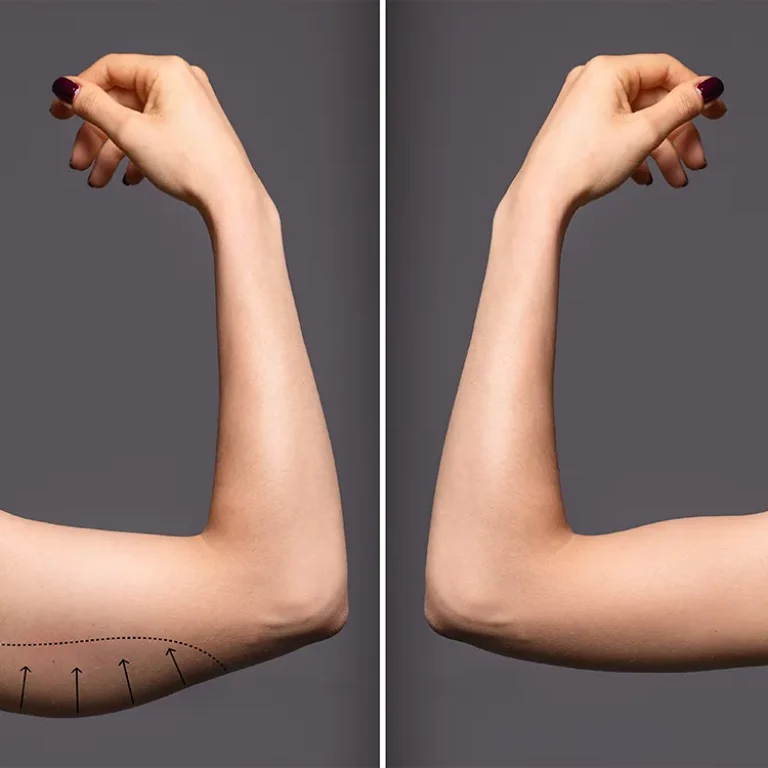 Arm lift surgery in Turkey performed by experienced surgeons to remove excess skin and reshape the upper arms.