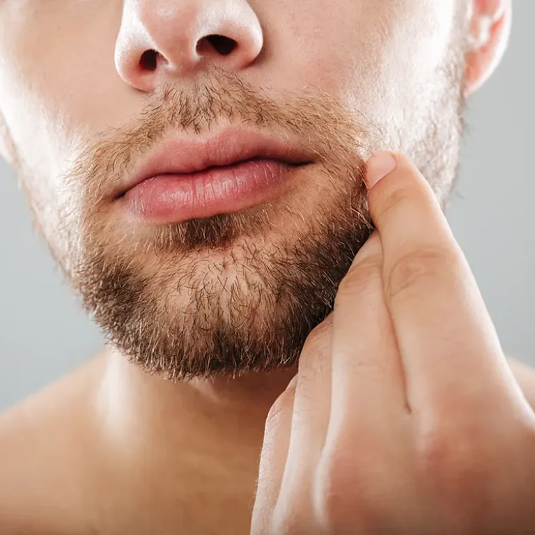 Beard and Mustache Transplant in Turkey performed by expert surgeons to restore natural facial hair growth and density.