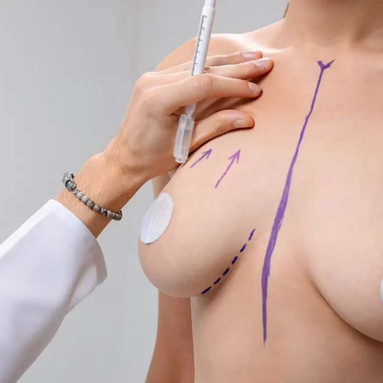 Breast Reduction in Turkey performed by expert surgeons to reduce breast size, improve shape, and restore comfort.