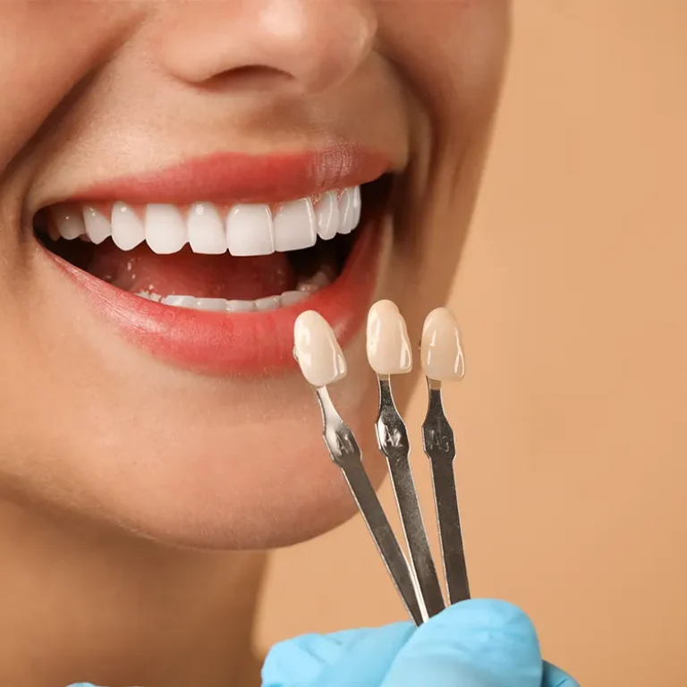 Dental Veneers in Turkey performed by expert dentists to enhance smile aesthetics and restore natural-looking teeth.