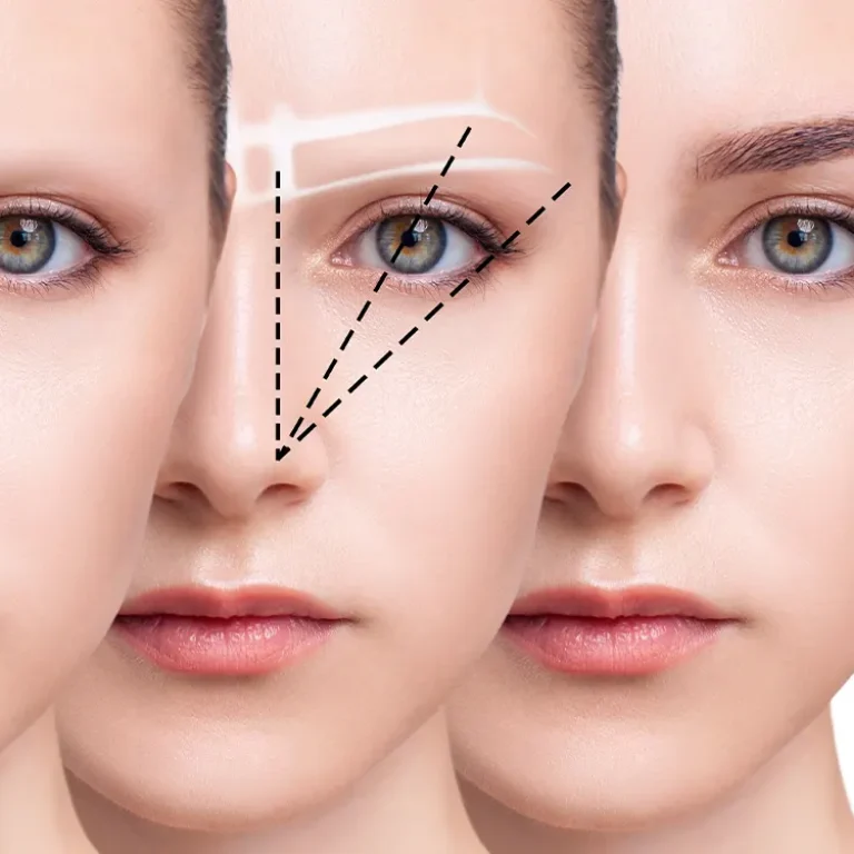 Eyebrow Transplant in Turkey performed by expert surgeons to restore natural eyebrow density and shape.