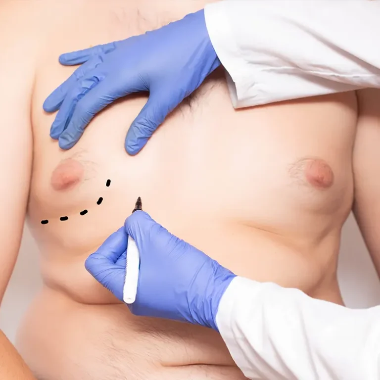 Gynecomastia surgery in Turkey performed by expert surgeons to reduce excess male breast tissue safely and effectively.