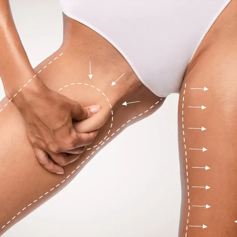 Thigh lifting in Turkey performed by expert surgeons to tighten loose skin and improve leg contours.